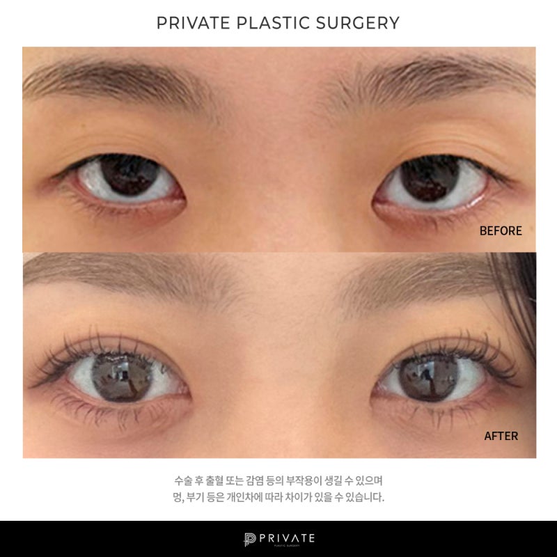 Let's explore double eyelid surgery at Private Plastic Surgery 사진 8