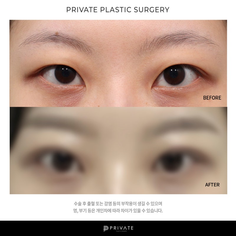 Let's explore double eyelid surgery at Private Plastic Surgery 사진 9