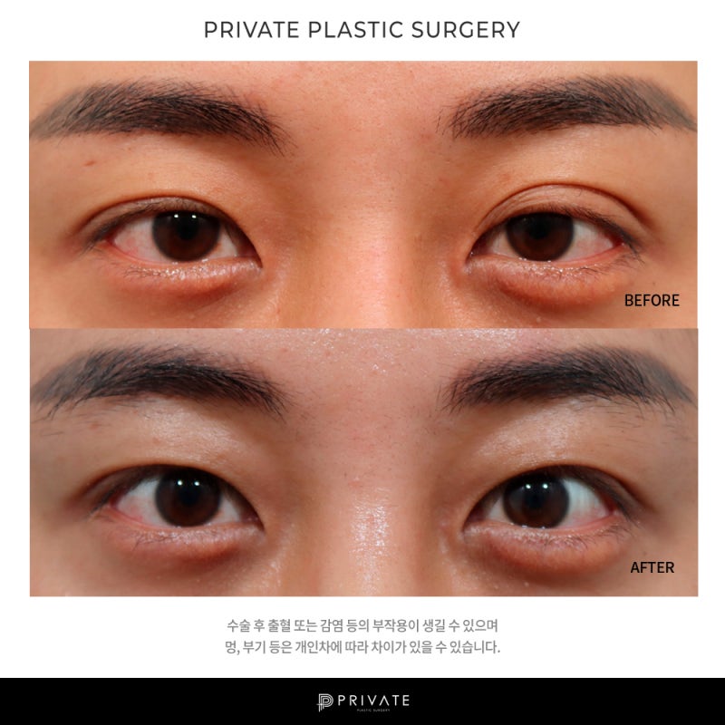 Let's Learn About Male Ptosis Correction at Private Plastic Surgery 사진 9