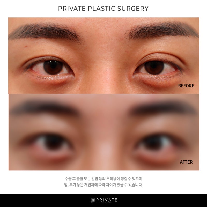 Let's Learn About Male Ptosis Correction at Private Plastic Surgery 사진 8