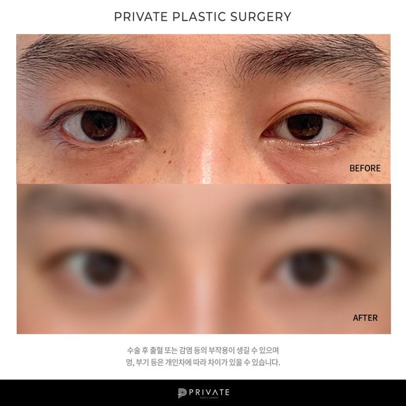 Let's Learn About Male Ptosis Correction at Private Plastic Surgery 사진 10