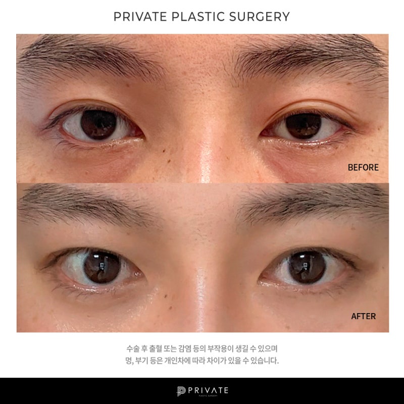 Let's Learn About Male Ptosis Correction at Private Plastic Surgery 사진 11