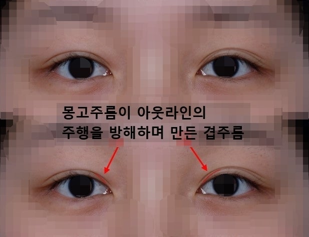 About Out-Line Double Eyelid Surgery