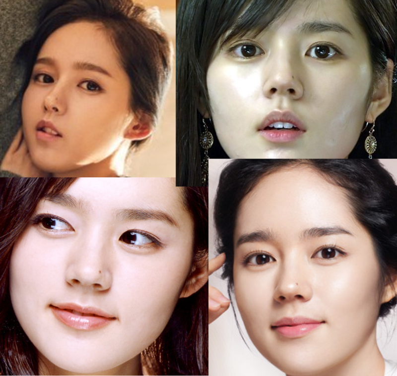About Out-Line Double Eyelid Surgery 사진 2