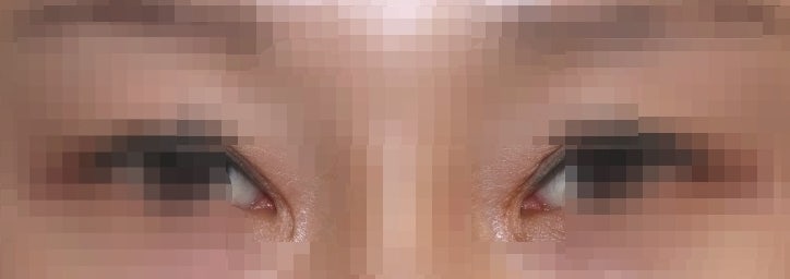 About Out-Line Double Eyelid Surgery 사진 5