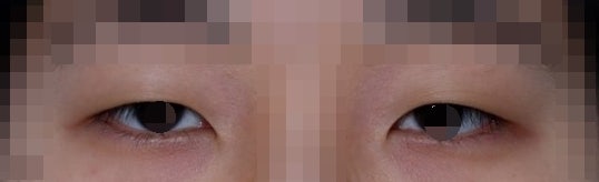 About Asymmetrical Eye Correction
