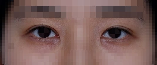 About Asymmetrical Eye Correction