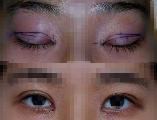 About Asymmetrical Eye Correction 사진 2