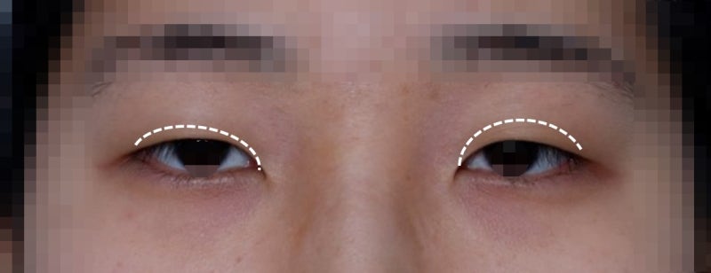 About Asymmetrical Eye Correction 사진 3