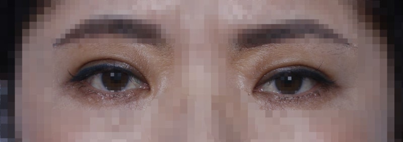 Drooping eyelids with age... 사진 6