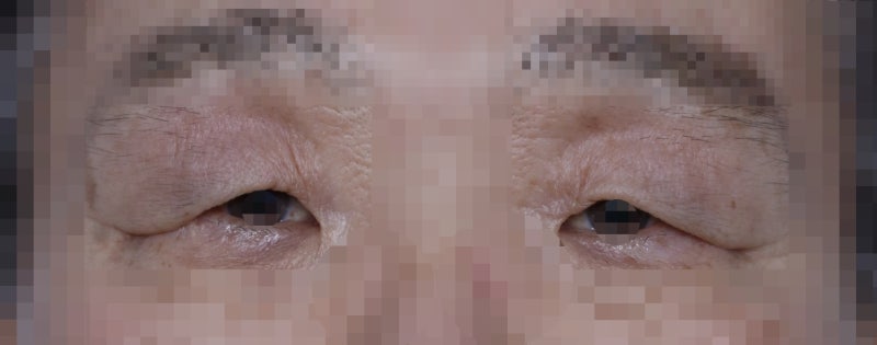 Drooping eyelids with age...
