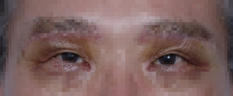Drooping eyelids with age... 사진 3