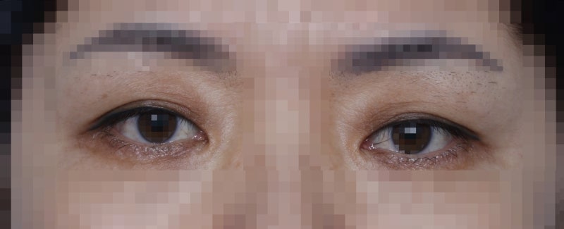 Drooping eyelids with age... 사진 4