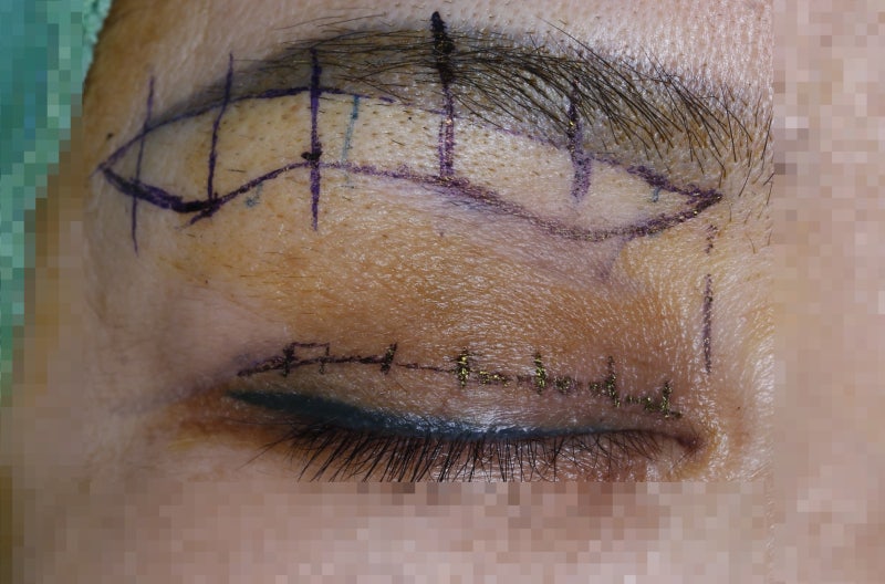 Drooping eyelids with age...