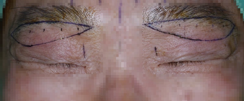 Drooping eyelids with age... 사진 2