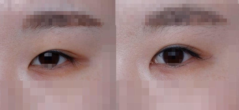 About ‘Big Eyes’ and ‘Clear Eyes’ 사진 4