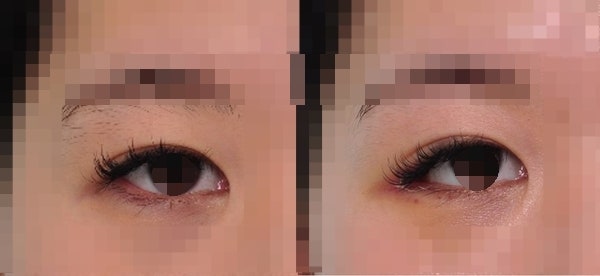 About ‘Big Eyes’ and ‘Clear Eyes’ 사진 5