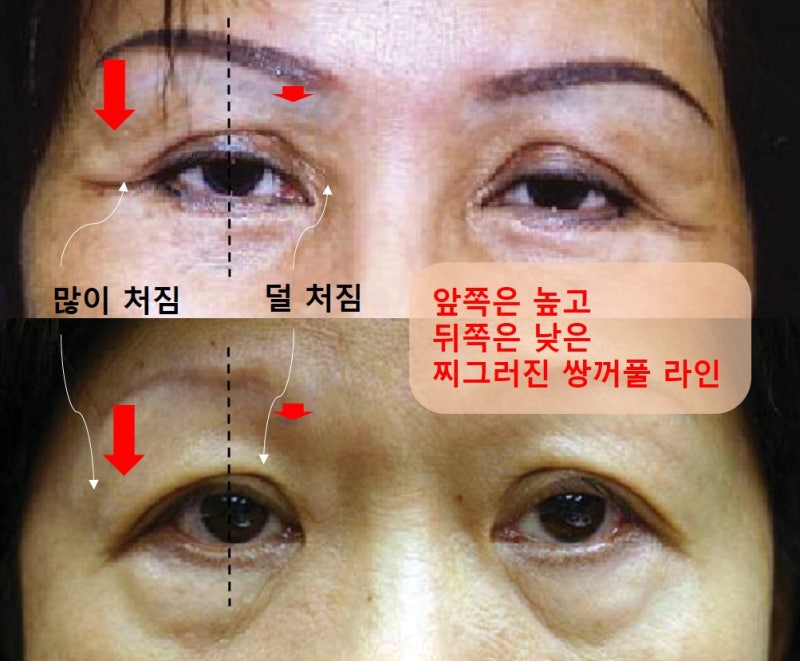 Large Double Eyelids, High Double Eyelids, High Fold (Part 1: The Beginning of Disaster) 사진 4