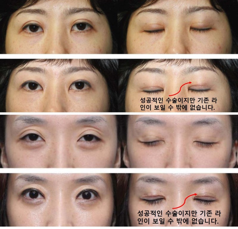 Large Double Eyelids, High Double Eyelids, High Fold (Part 1: The Beginning of Disaster) 사진 6