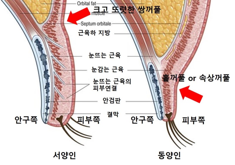 Large Double Eyelids, High Double Eyelids, High Fold (Part 1: The Beginning of Disaster)