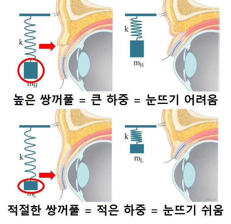 Large Double Eyelids, High Double Eyelids, High Fold (Part 1: The Beginning of Disaster) 사진 2