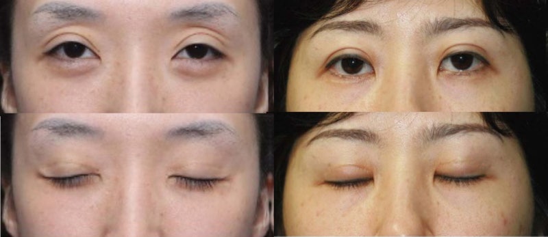 Large Double Eyelids, High Double Eyelids, High Fold (Part 1: The Beginning of Disaster) 사진 3