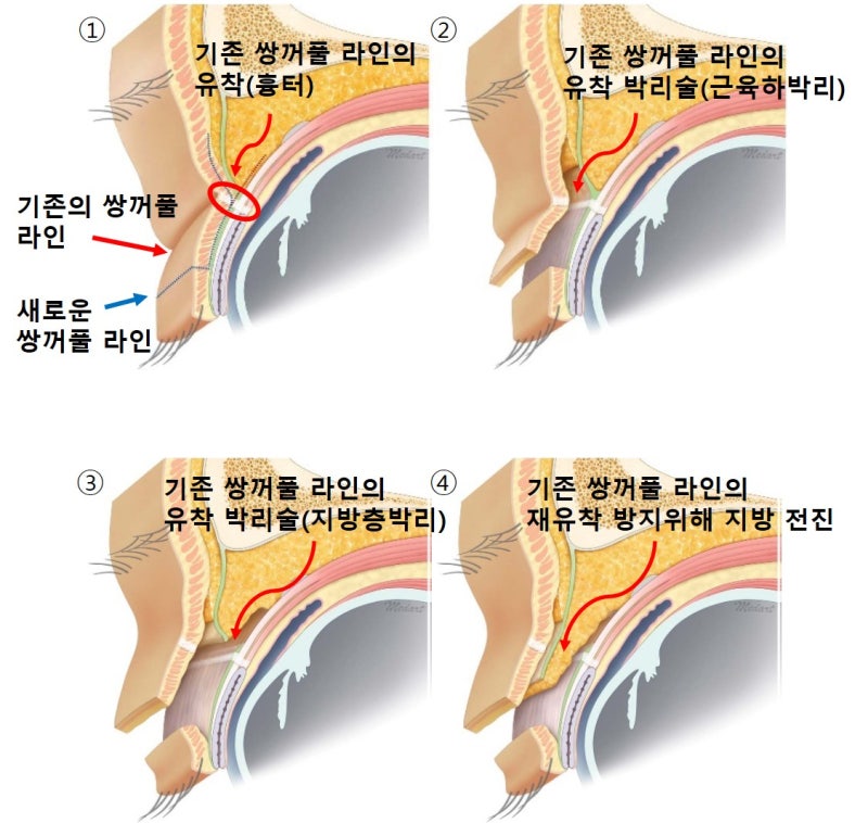Large Double Eyelids, High Double Eyelids, High Fold (Part 1: The Beginning of Disaster) 사진 5