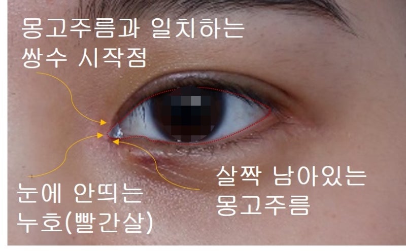 Types of Double Eyelid Lines (In-line, In-out line, Out-line)