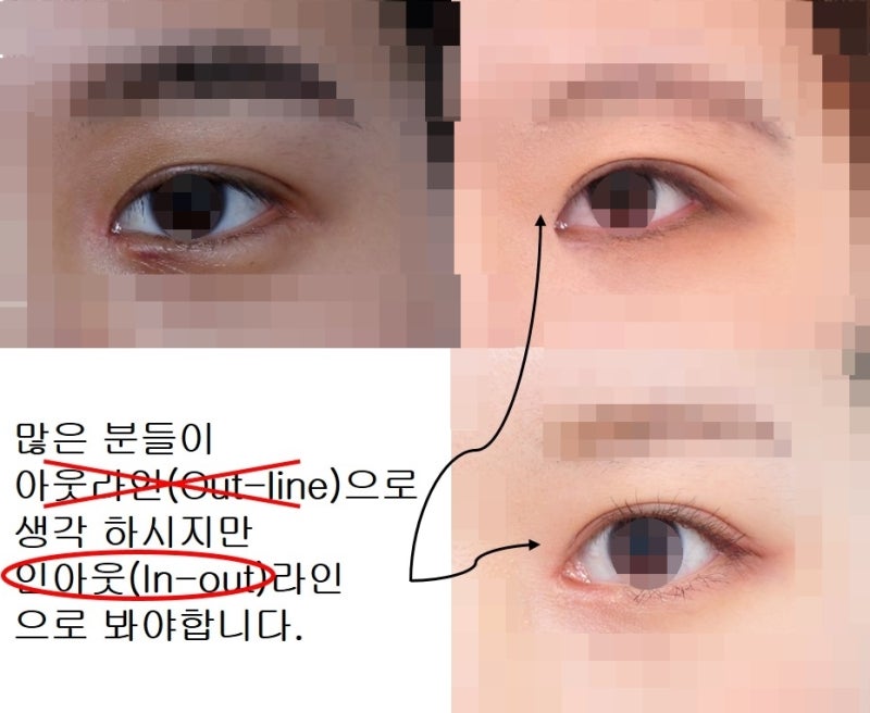 Types of Double Eyelid Lines (In-line, In-out line, Out-line) 사진 5