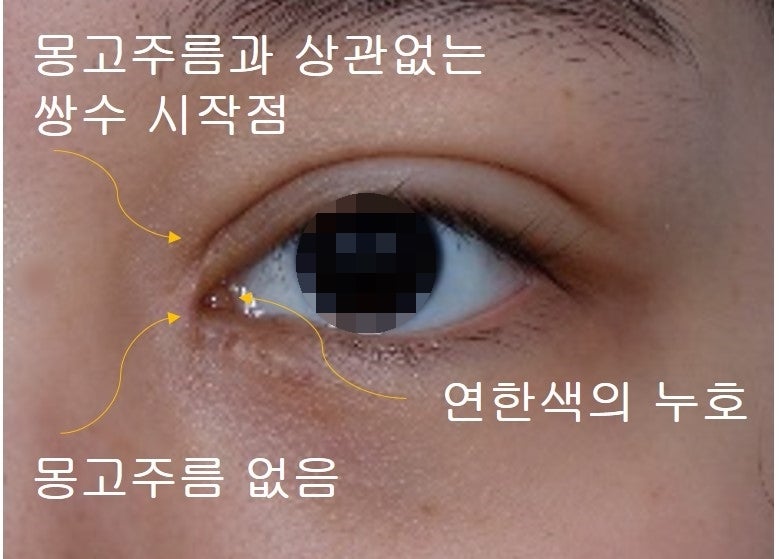Types of Double Eyelid Lines (In-line, In-out line, Out-line) 사진 6