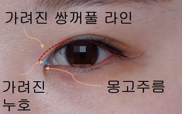Types of Double Eyelid Lines (In-line, In-out line, Out-line) 사진 2