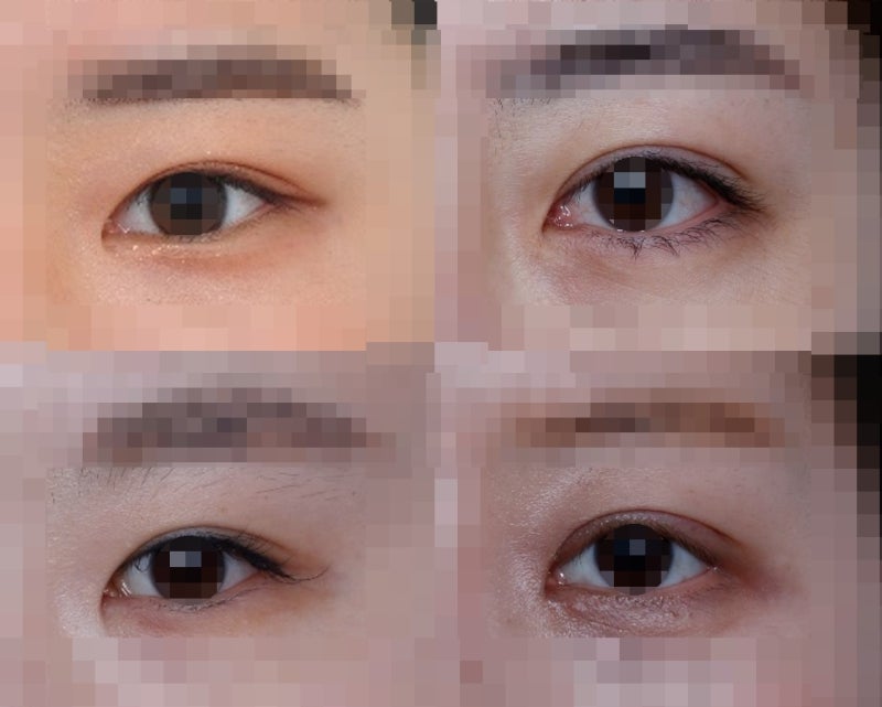 Types of Double Eyelid Lines (In-line, In-out line, Out-line) 사진 3