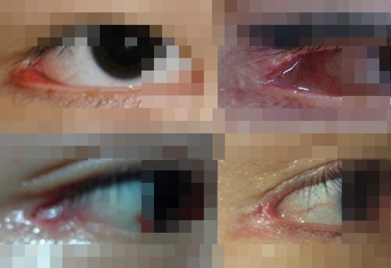 About Lateral Canthoplasty and Lower Canthoplasty 사진 4