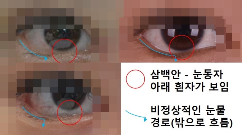 About Lateral Canthoplasty and Lower Canthoplasty