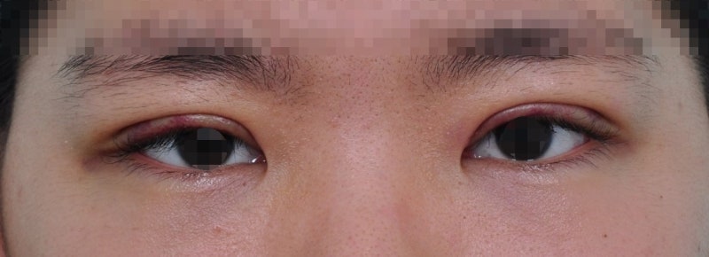 Can asymmetrical eyes be corrected without asymmetrical eye correction surgery? 사진 3