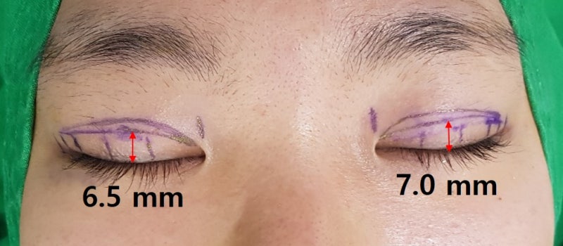 Can asymmetrical eyes be corrected without asymmetrical eye correction surgery?