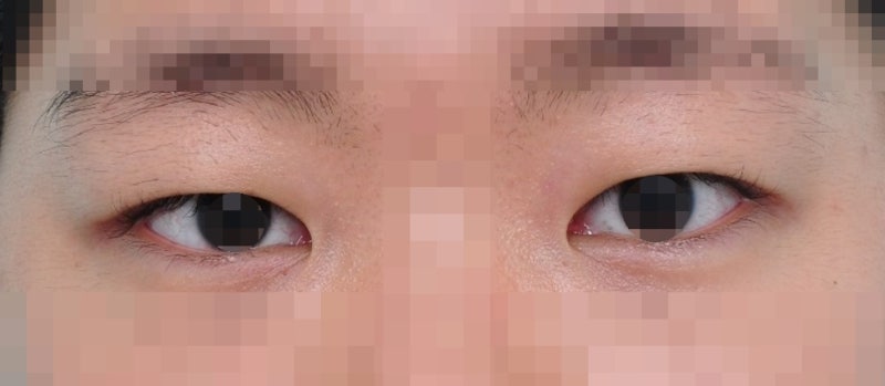 Can asymmetrical eyes be corrected without asymmetrical eye correction surgery?