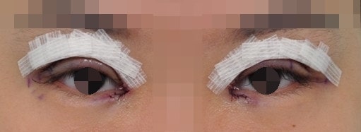 Swelling and Management After Double Eyelid Surgery 사진 6
