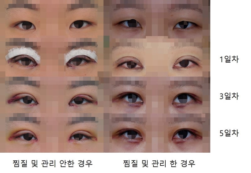 Swelling and Management After Double Eyelid Surgery 사진 3