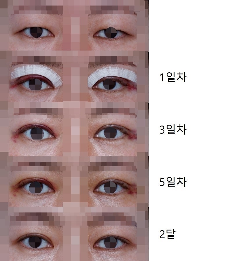 Swelling and Management After Double Eyelid Surgery