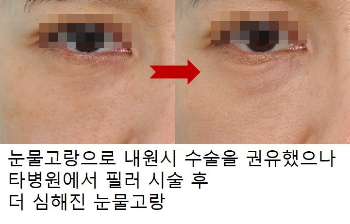 Regarding Lower Eyelid Fillers? Fat Grafting? 사진 4