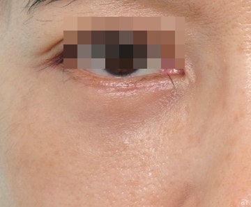 Regarding Lower Eyelid Fillers? Fat Grafting? 사진 5