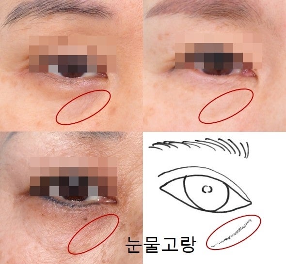 Regarding Lower Eyelid Fillers? Fat Grafting?