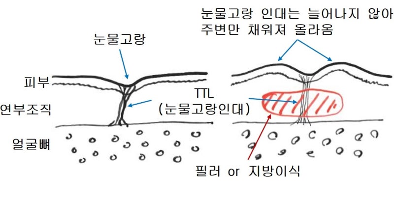 Regarding Lower Eyelid Fillers? Fat Grafting? 사진 3