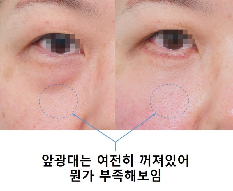 Fat Removal? Fat Repositioning? In Search of Lively Lower Eyelids... 사진 4