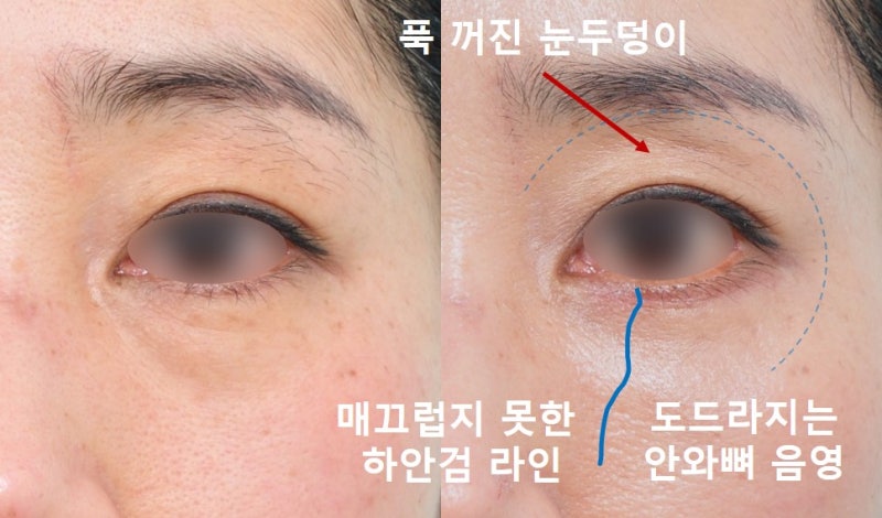 <Lower Blepharoplasty Part 2> Fat Removal? Fat Repositioning? In Search of Lively Lower Eyelids...