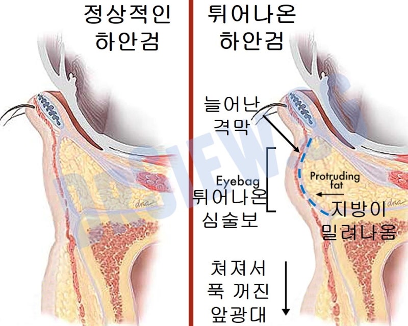 Fat Removal? Fat Repositioning? In Search of Lively Lower Eyelids... 사진 2