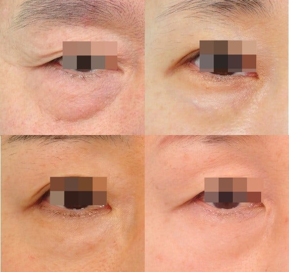 Fat Removal? Fat Repositioning? In Search of Lively Lower Eyelids...