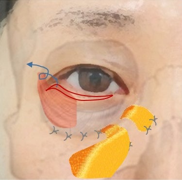 Penataan Ulang Lemak + Penguatan Septum + Pengangkatan Pipi Depan Sekaligus... 사진 7