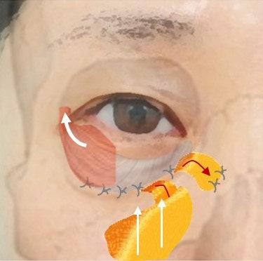 Penataan Ulang Lemak + Penguatan Septum + Pengangkatan Pipi Depan Sekaligus... 사진 6